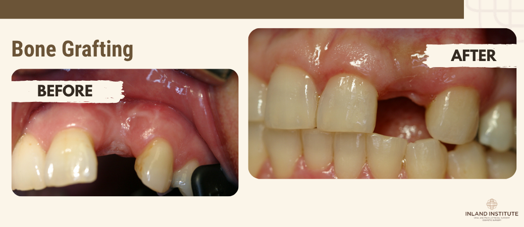 Bone grafting before and after treatment at Inland Institute Oral & Maxillofacial Surgery