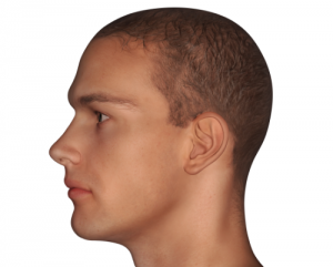 TypesOfJawSurgery 300x241