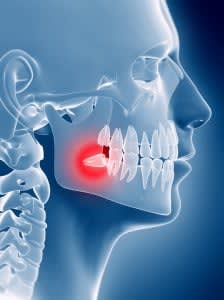 Wisdom teeth whats the