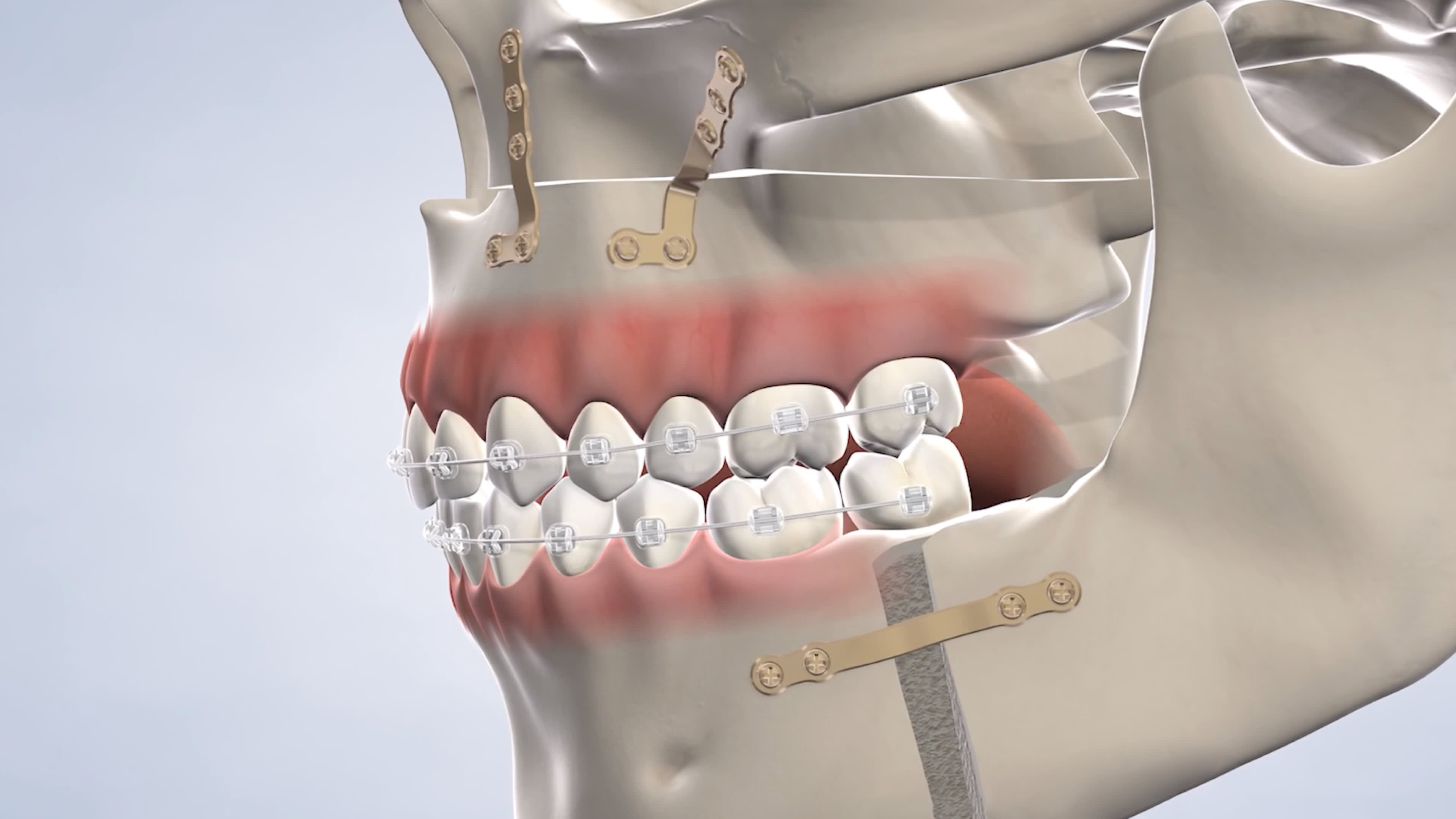 instruction  jaw surgery