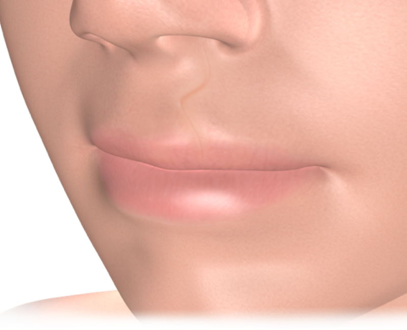 Isolated  cleft lip palate repair  mobile