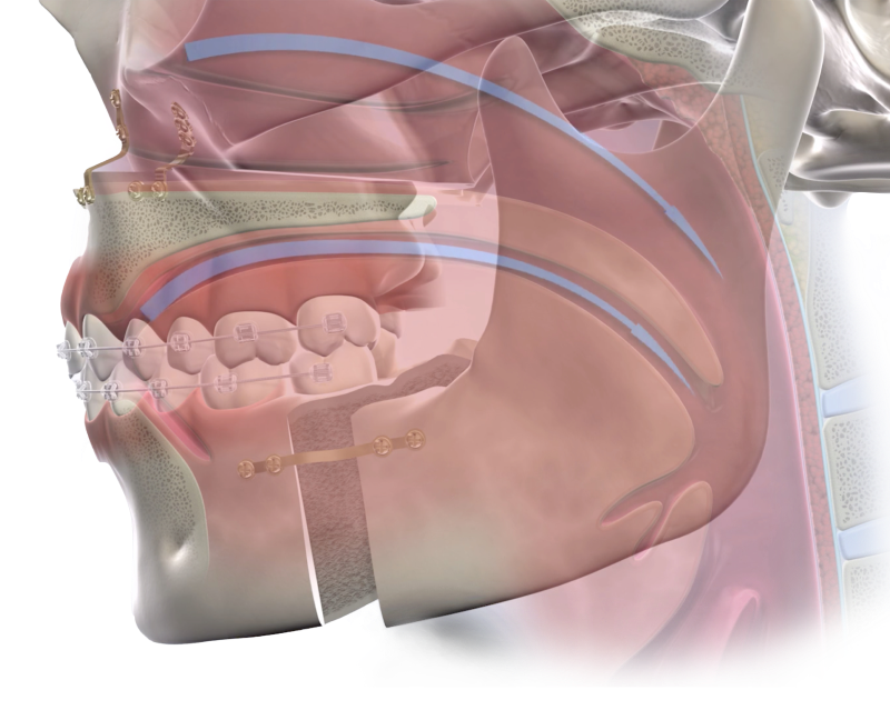 Isolated  obstructive sleep apnea  mobile