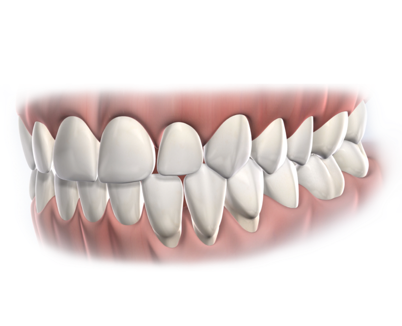 Isolated  periodontal pocket surgery  mobile