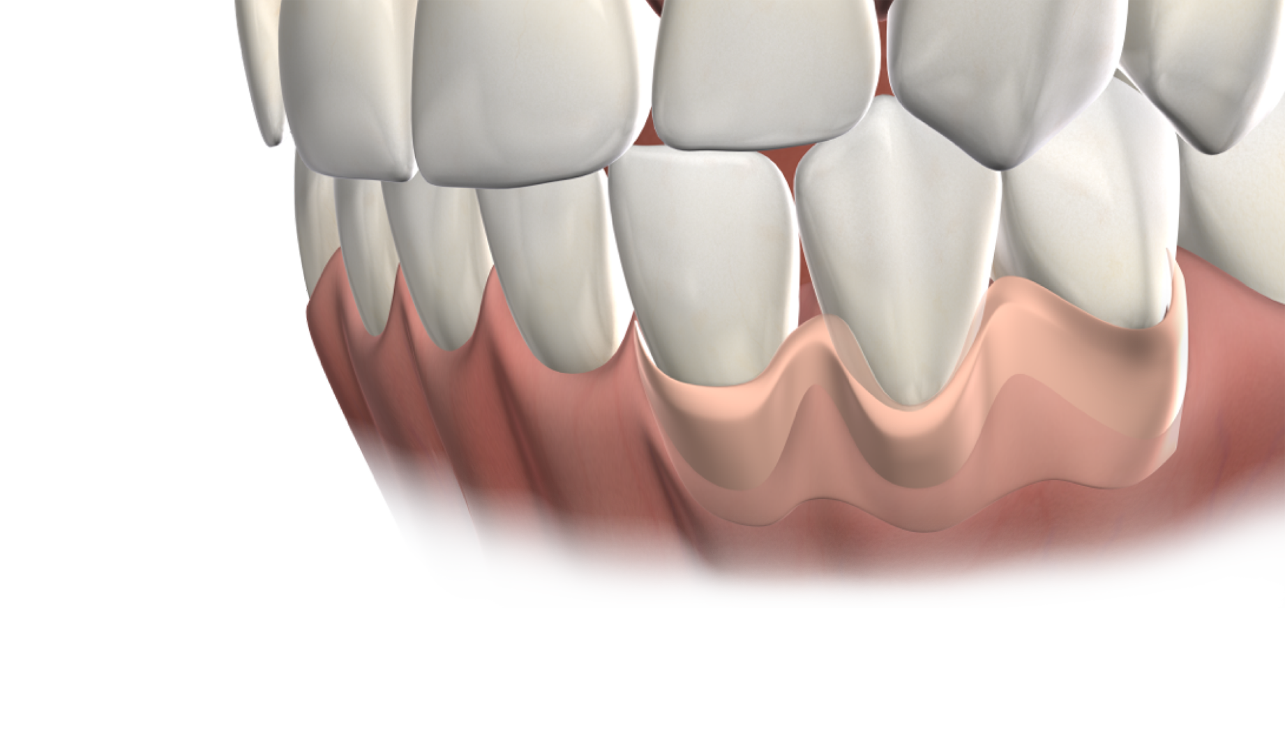 Isolated  soft tissue grafting