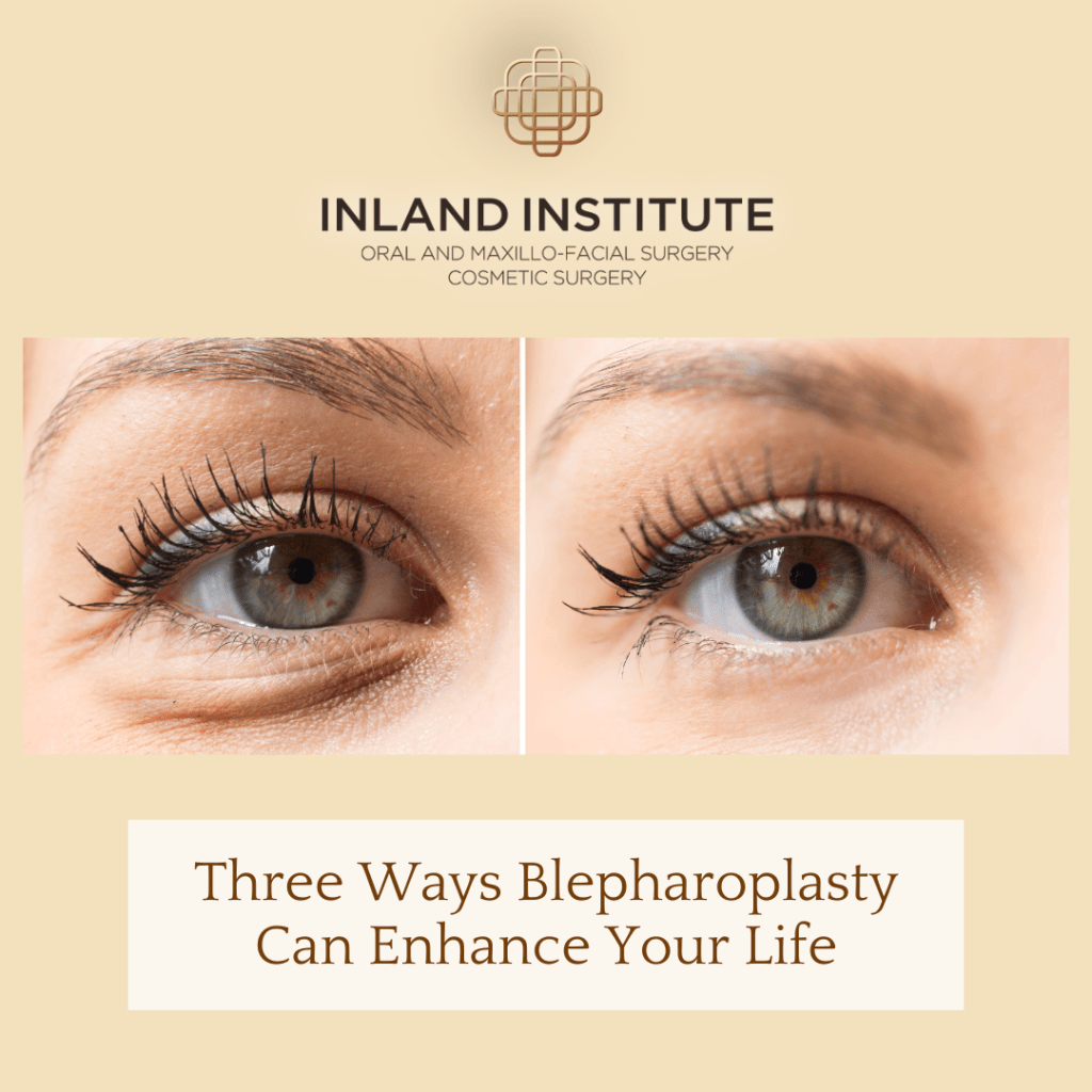 Three Ways Blepharoplasty Can Enhance Your Life